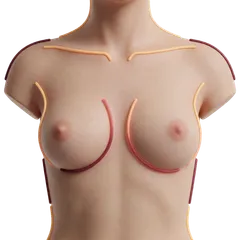 Breast Asymmetry & Sizing Disparity