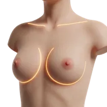 Inframammary Fold Definition