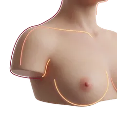 Grade 1–3 Breast Ptosis