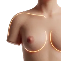 Nipple Elevation