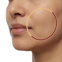 Lower Cheek Slimming