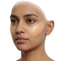 Submalar Cheek Hollow