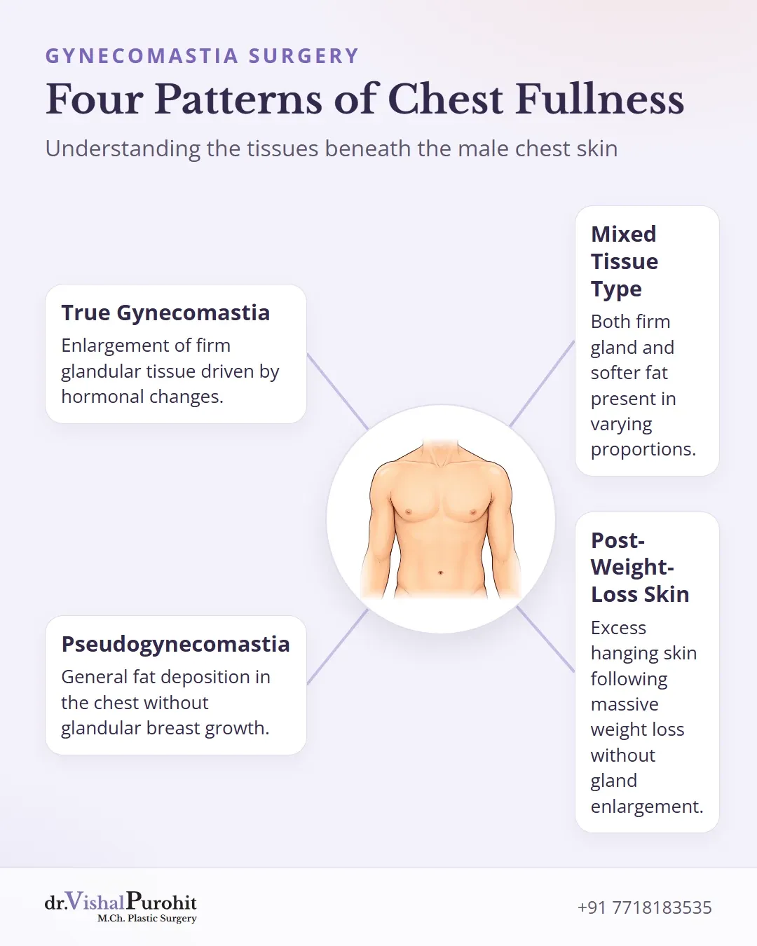 Diagram showing the four patterns of male chest fullness: gland, fat, mixed, and loose skin