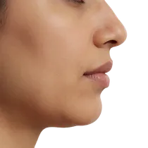 Mandibular Jawline