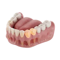 Intraoral Concealment