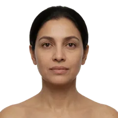 Fatigue from Temporary Chemical Fillers