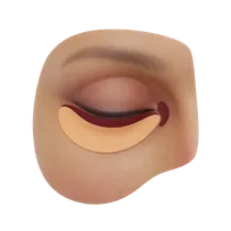 Tear Trough Depressions