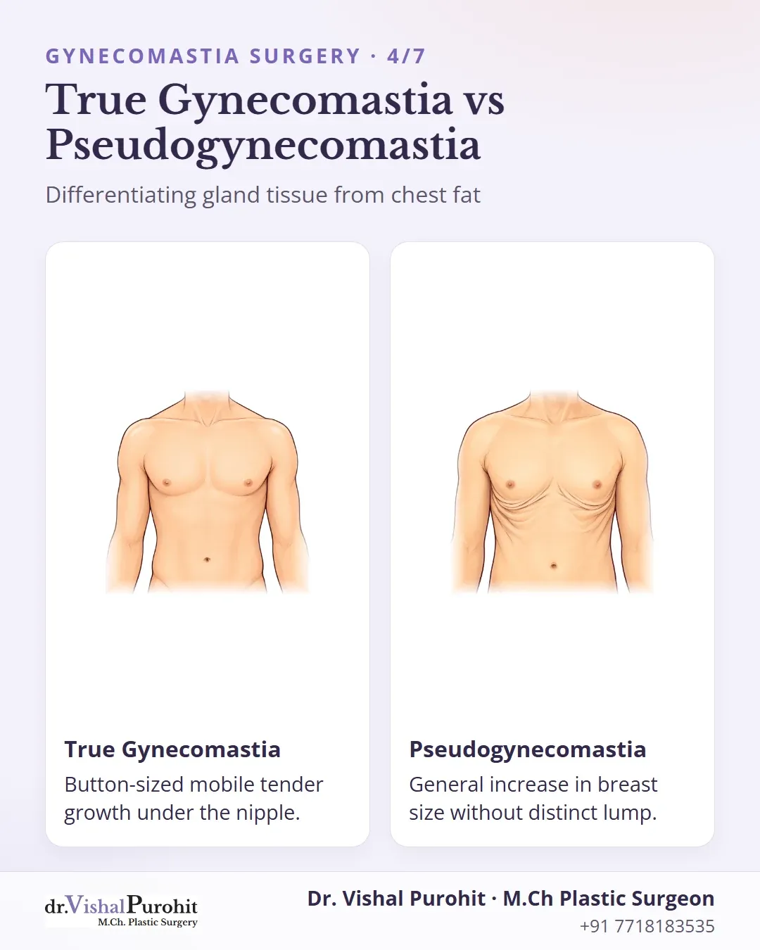 Comparison between true gynecomastia featuring glandular tissue under the nipple and pseudogynecomastia with diffuse fatty tissue.