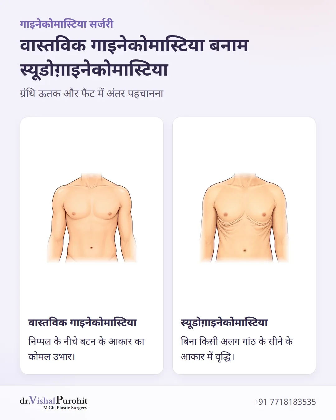 सच्चे गाइनेकोमास्टिया (निप्पल के नीचे ग्रंथि उभार) और स्यूडोग़ाइनेकोमास्टिया (फैट के कारण सामान्य वृद्धि) के बीच तुलना।
