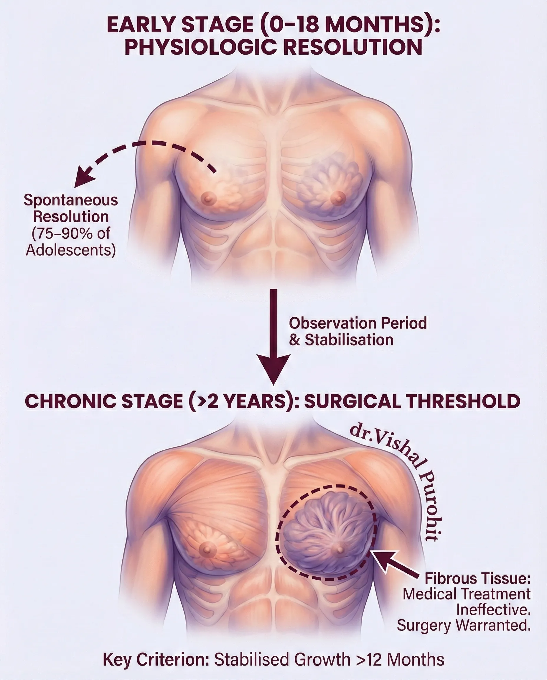 Infographic detailing gynecomastia stages: early physiologic resolution versus chronic fibrous tissue requiring surgery.