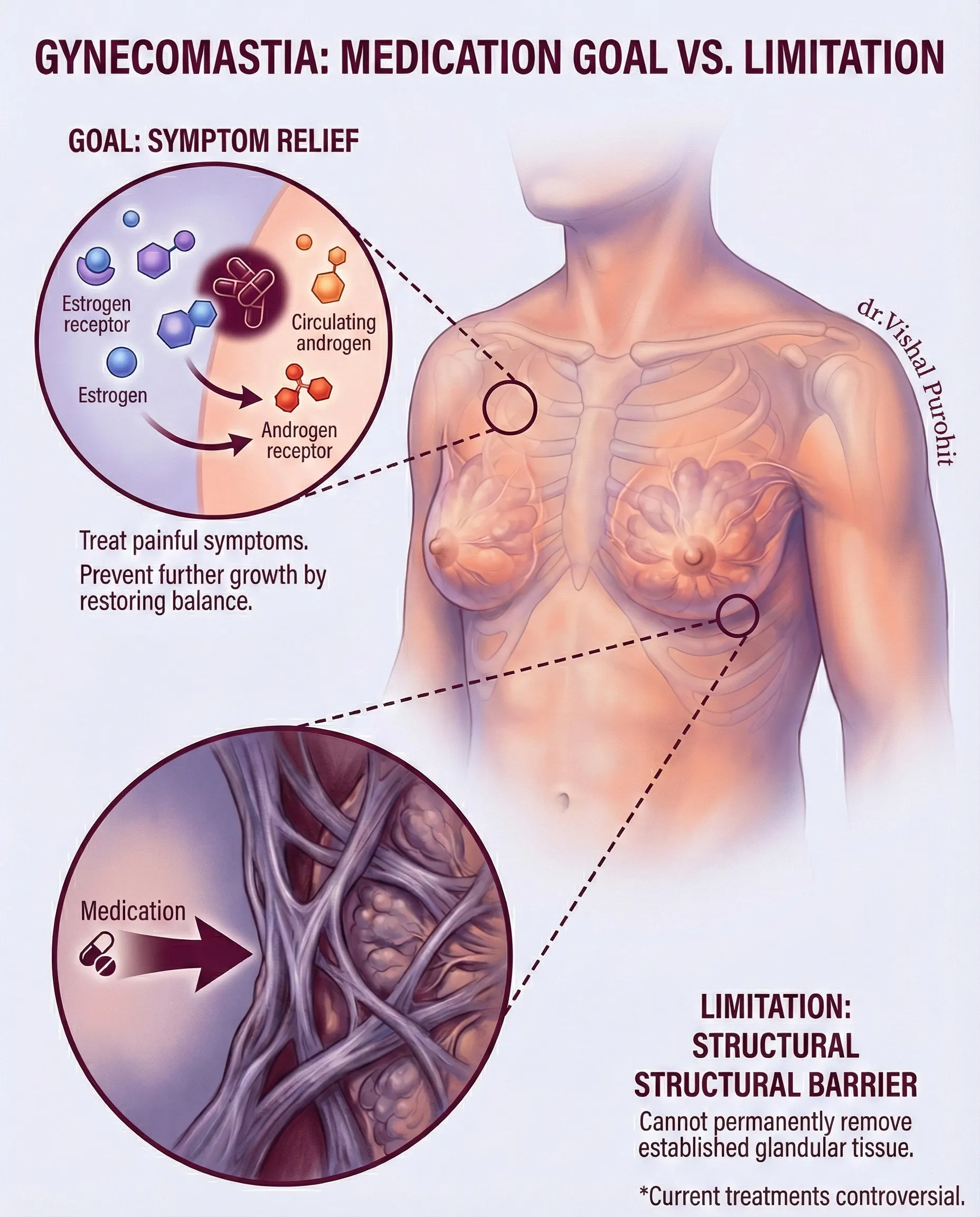 Medical illustration showing gynecomastia medication limitations and fibrous tissue barriers in male chest.