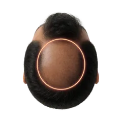 Thinning Crown & Vertex Bald Spot