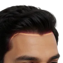 Frontal Hairline Framing