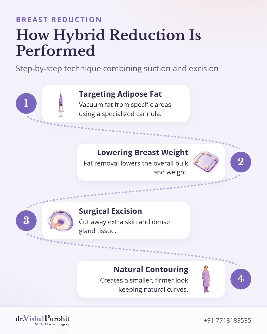 Four-step process showing how liposuction-assisted breast reduction works.