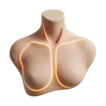 Absorbable Suture Line