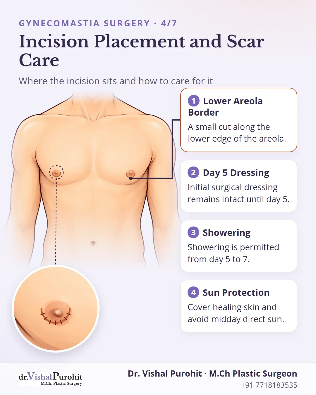 Anatomical callout diagram showing hemi-periareolar incision placement and post-op wound care.