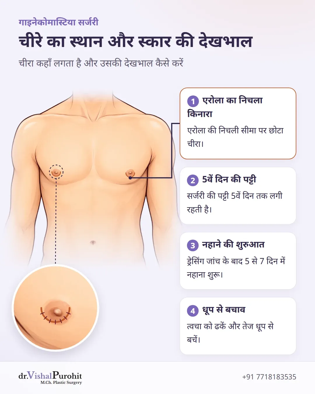 एरोला पर चीरे के स्थान और घाव की देखभाल का शारीरिक इन्फोग्राफिक।
