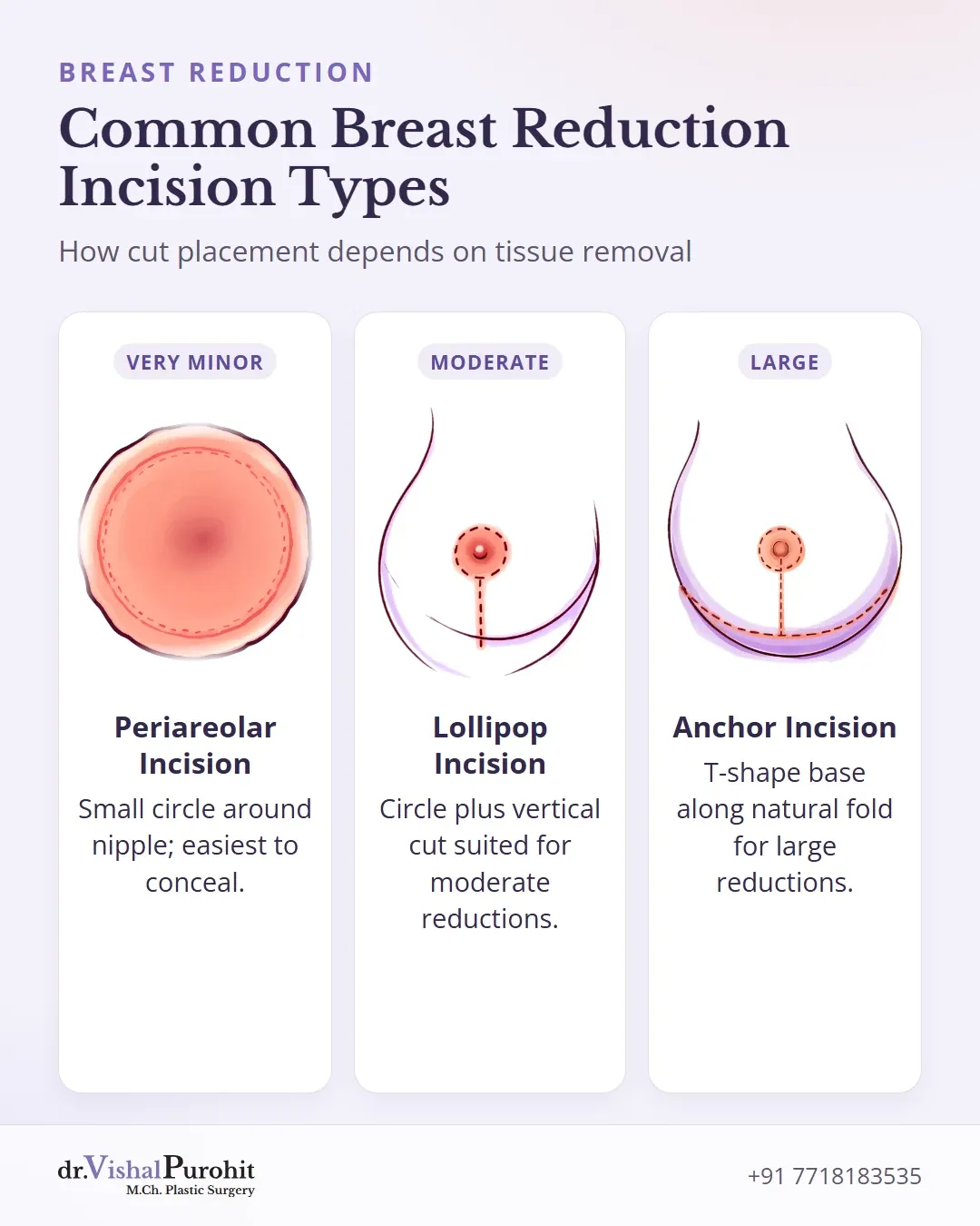 Comparison of periareolar, lollipop, and anchor incision patterns for breast reduction surgery.