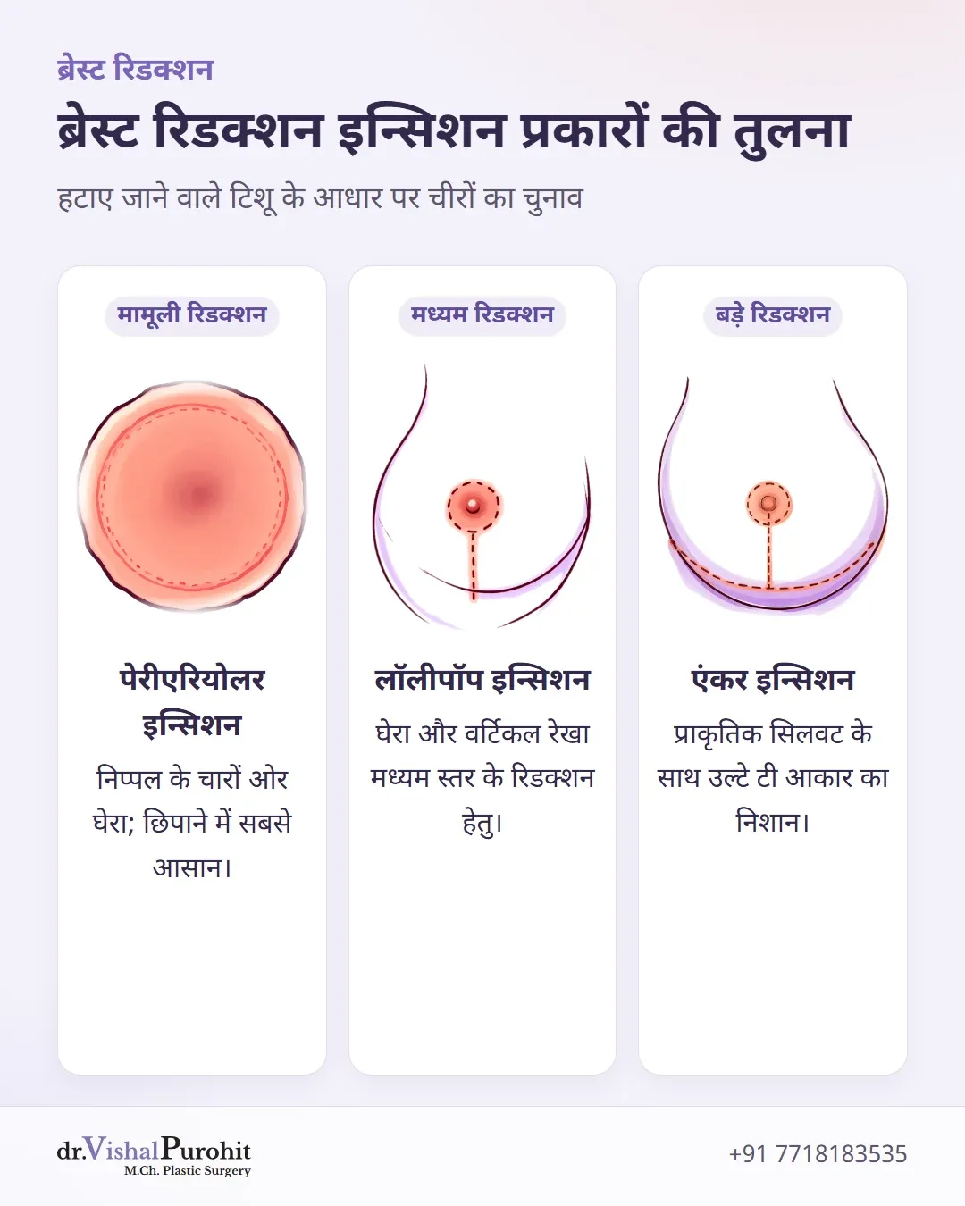 ब्रेस्ट रिडक्शन के लिए पेरीएरियोलर, लॉलीपॉप और एंकर चीरों की तुलना।