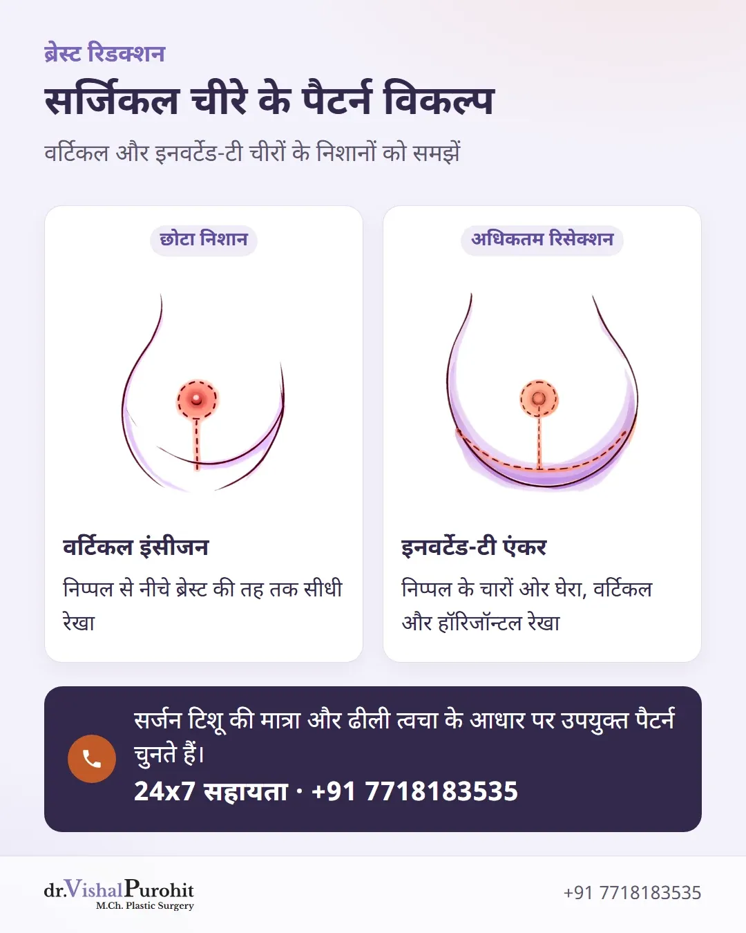 ब्रेस्ट रिडक्शन के लिए वर्टिकल और इनवर्टेड-टी एंकर इंसीजन की तुलना।