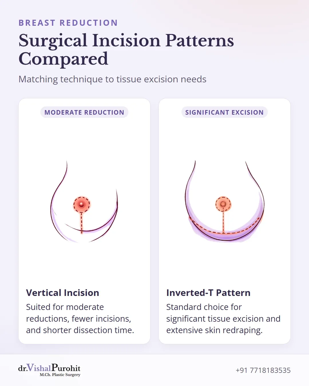 Comparison between vertical and inverted-T breast reduction incision techniques.