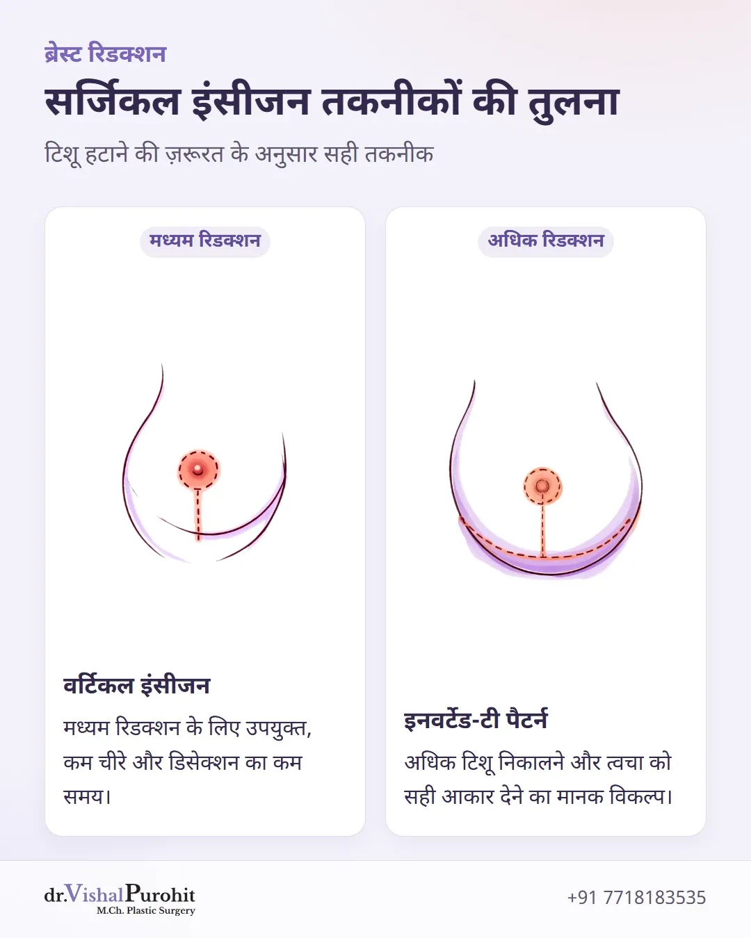 वर्टिकल और इनवर्टेड-टी ब्रेस्ट रिडक्शन तकनीकों की तुलना।