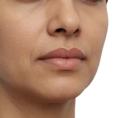 Loss of Cupid’s Bow Definition