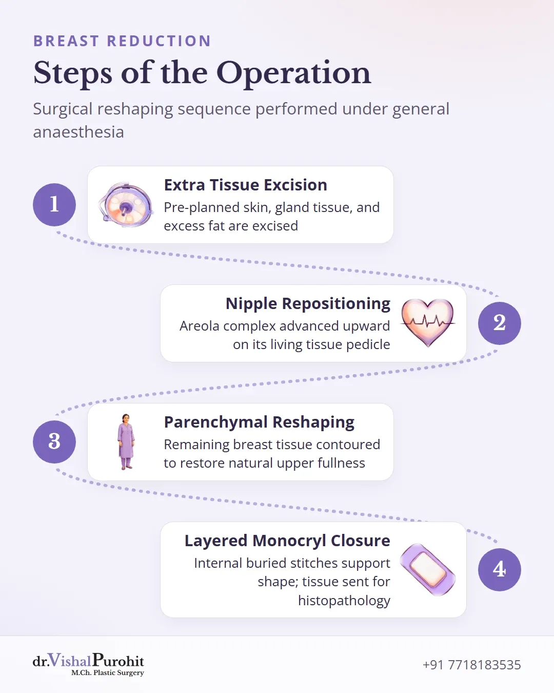 Step by step surgical sequence: tissue excision, nipple repositioning, parenchymal reshaping, and layered Monocryl closure.