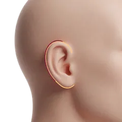 Prominent Ear Protrusion