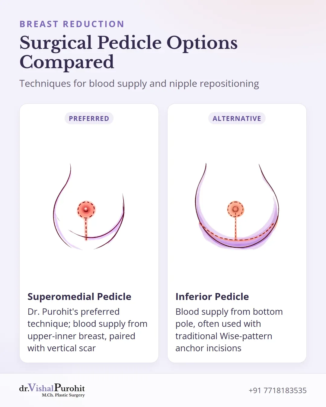 Comparison between superomedial pedicle with vertical scar and inferior pedicle with Wise pattern scar.