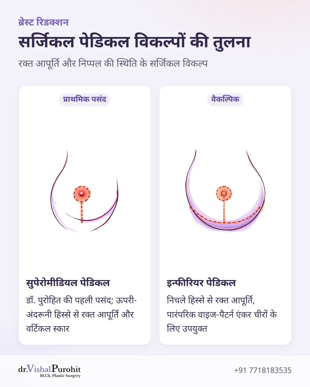 सुपेरोमीडियल पेडिकल और इन्फीरियर पेडिकल तकनीकों की तुलना।