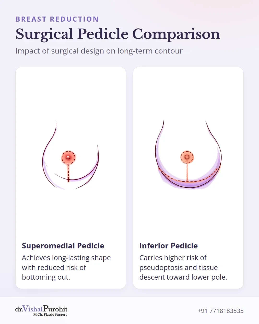 Comparison between superomedial and inferior surgical pedicle techniques