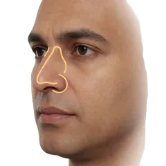 Dorsal Hump on Profile