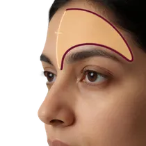 Nasofrontal Angle