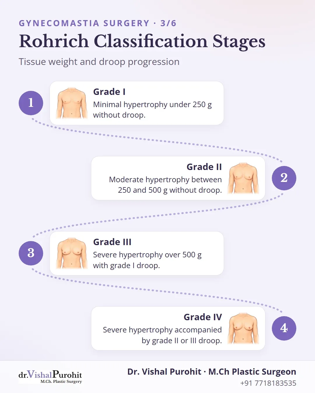 Rohrich classification stages based on tissue weight and ptosis.