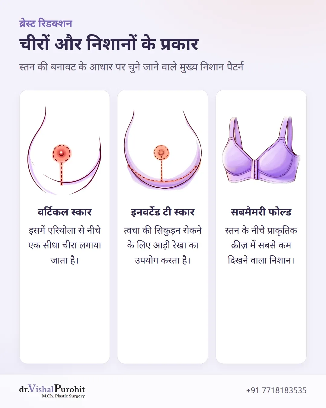 वर्टिकल, इनवर्टेड टी और सबमैमरी फोल्ड निशान तकनीकों की तुलना।