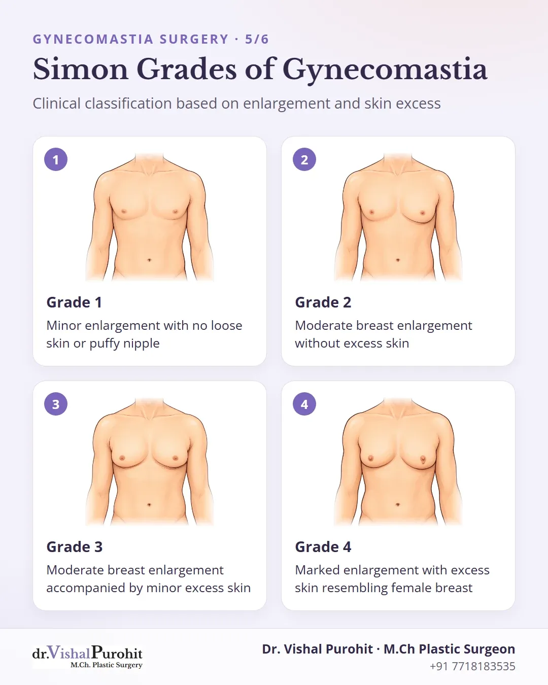 The four Simon clinical grades of gynecomastia severity