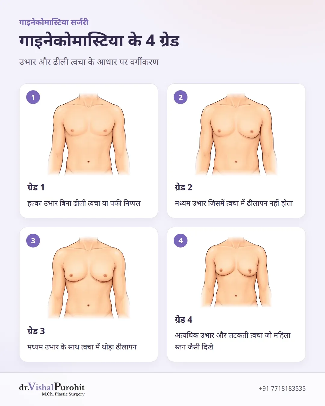गाइनेकोमास्टिया की गंभीरता के चार साइमन ग्रेड