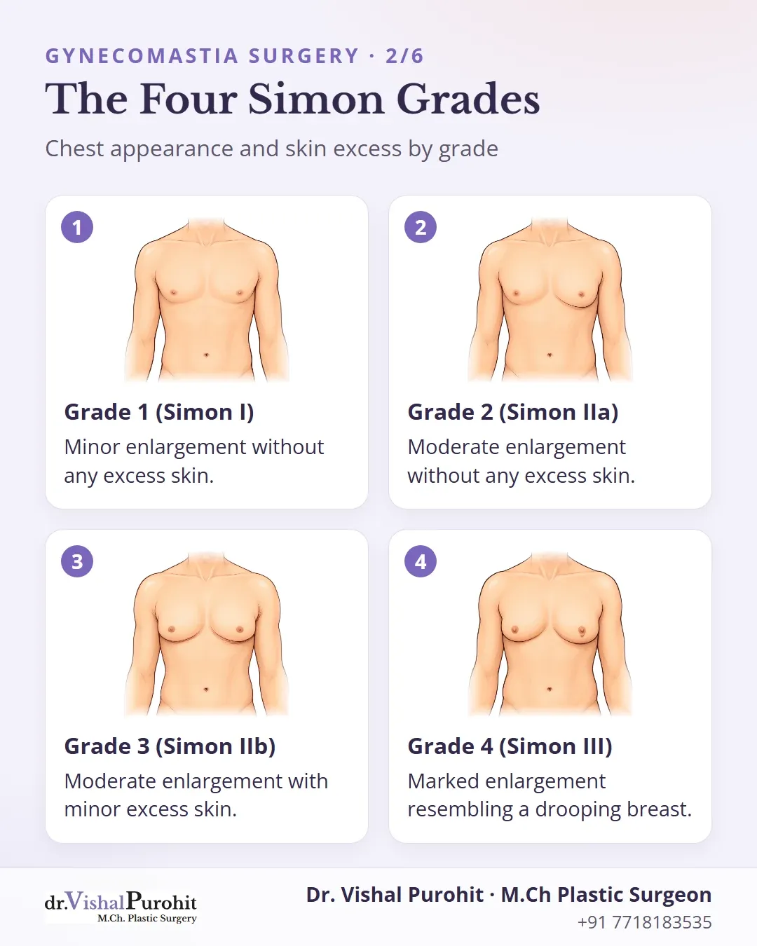 Four grades of gynecomastia under the Simon classification system.