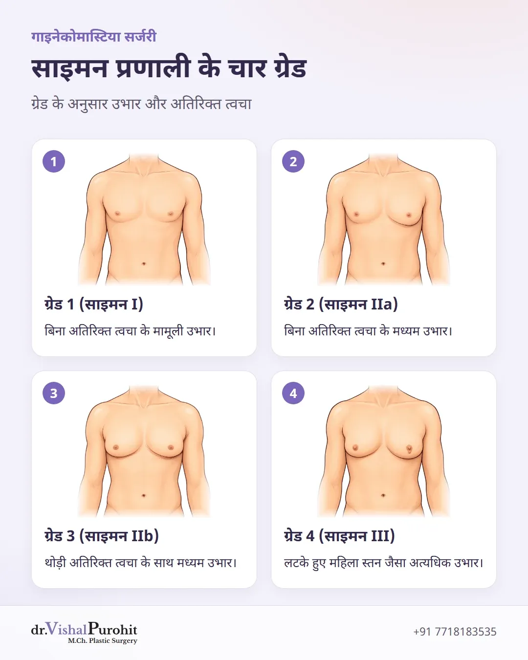 साइमन वर्गीकरण प्रणाली के तहत गाइनेकोमास्टिया के चार ग्रेड।