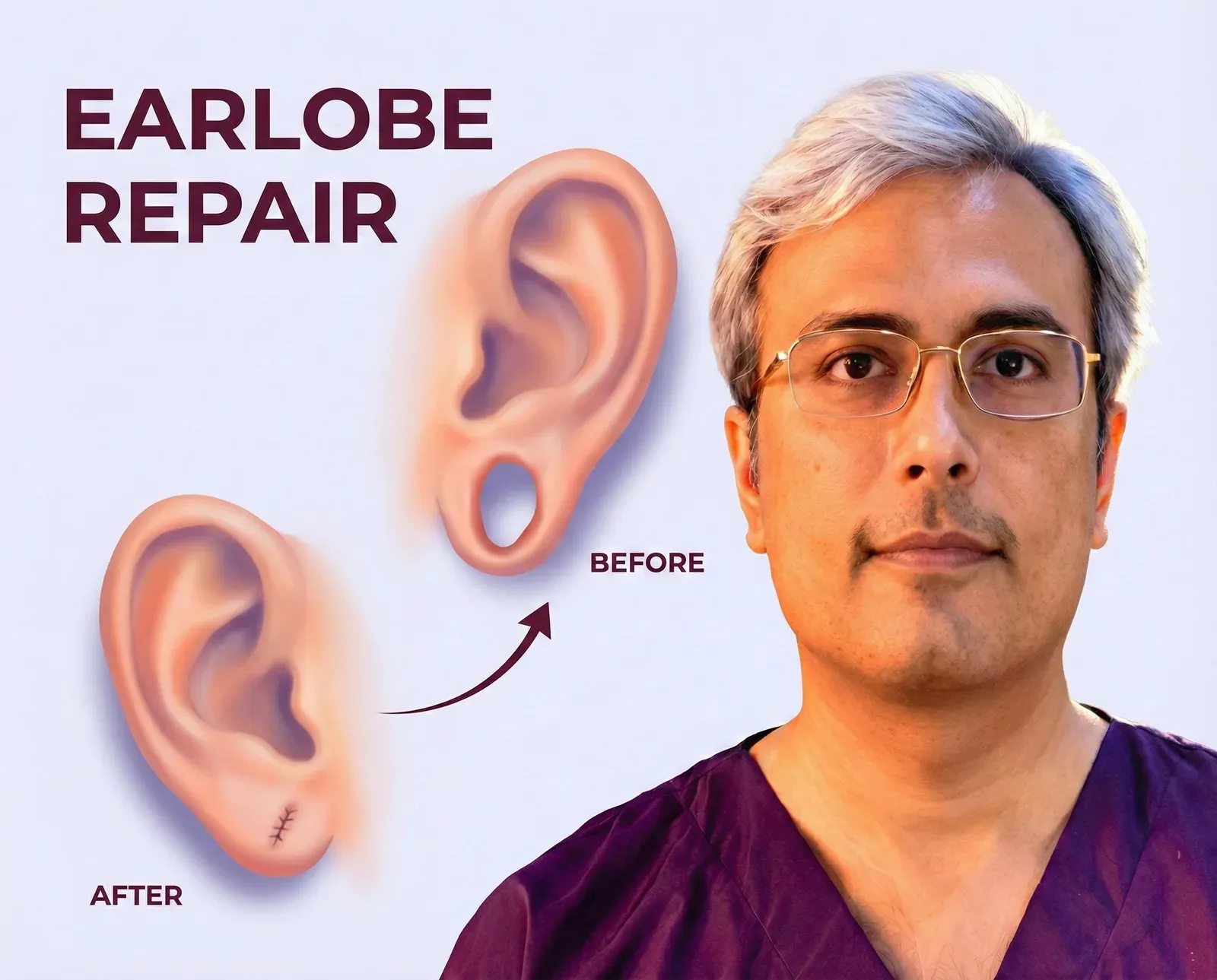 Earlobe Repair in Jaipur - Dr. Vishal Purohit Plastic Surgeon Jaipur