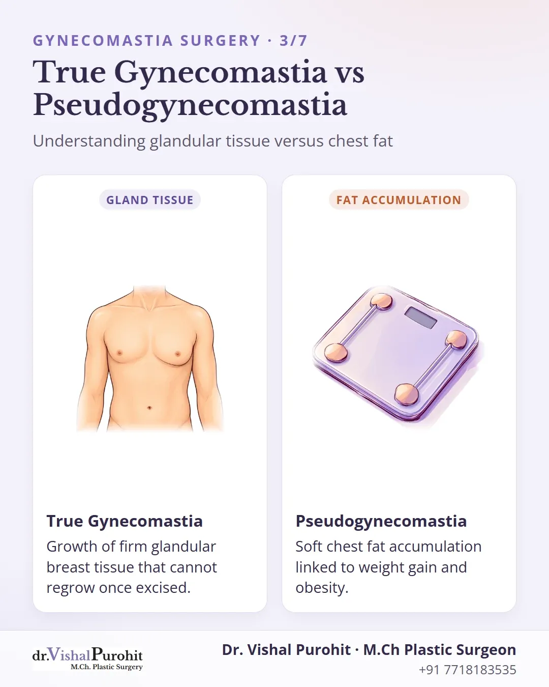 Comparison between true glandular gynecomastia and obesity-related pseudogynecomastia.
