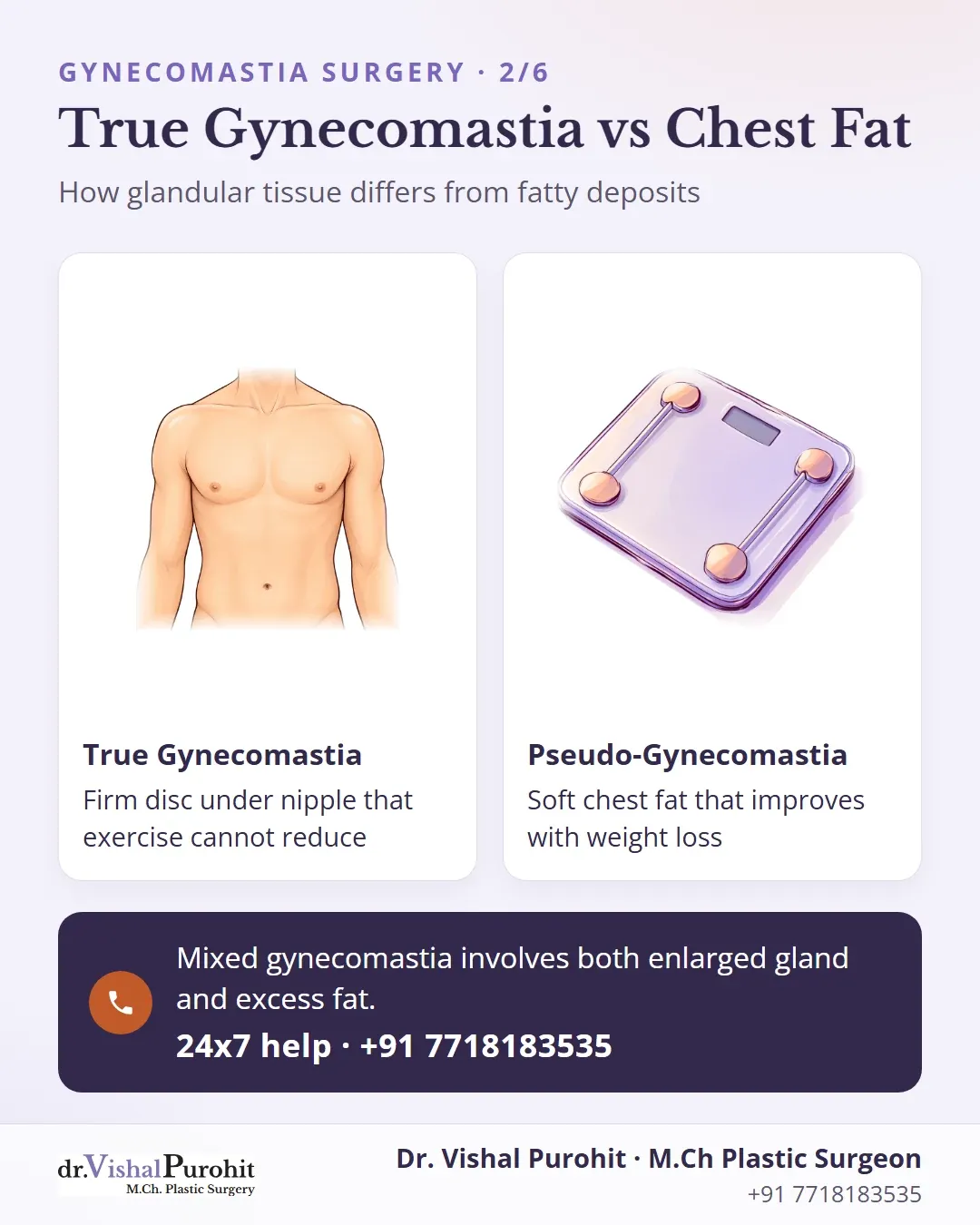 Comparison between true glandular gynecomastia and fatty pseudogynecomastia