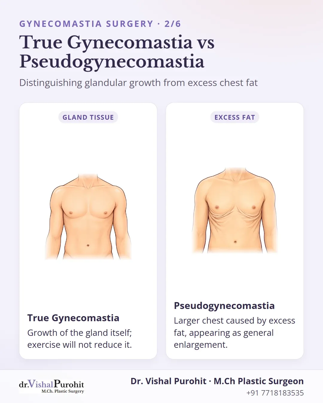 Comparison between true glandular gynecomastia and fat-based pseudogynecomastia.