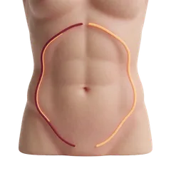 Diastasis Recti (Core Bulge)