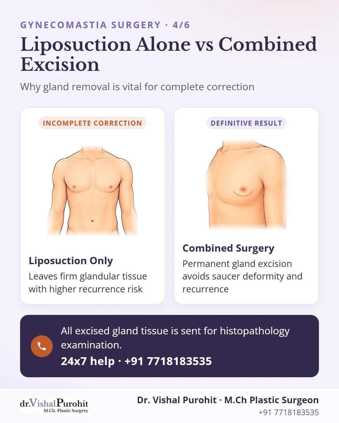 Side-by-side comparison between liposuction alone and combined gland excision.