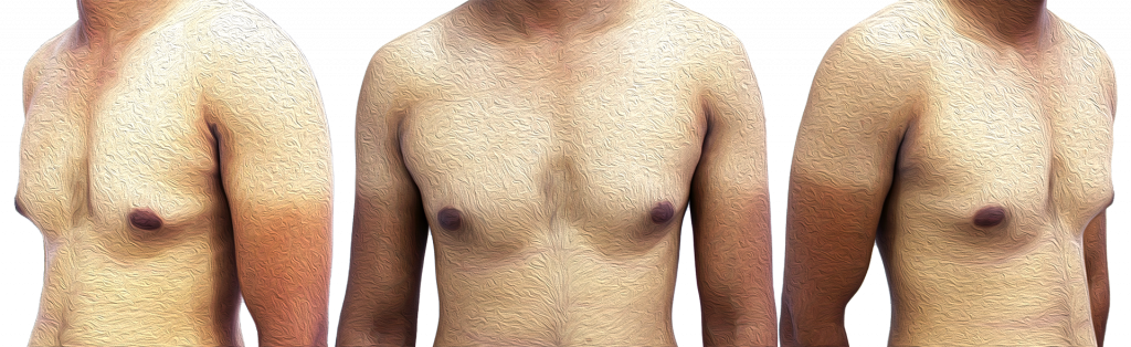 Gynecomastia image from front and sides.
