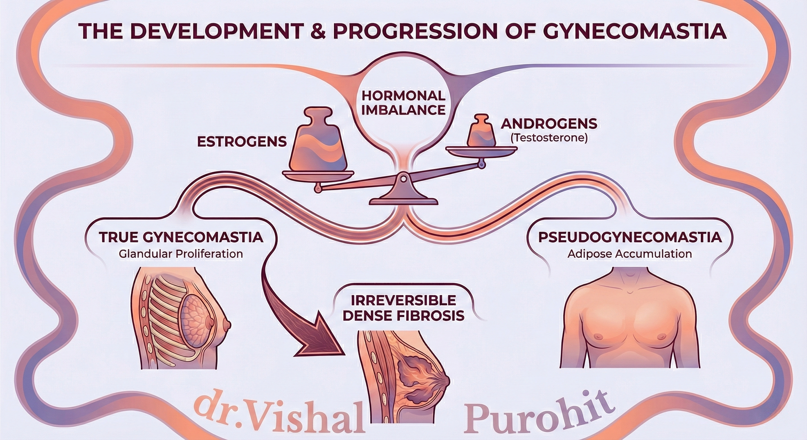 Flowchart illustrating the development of Gynecomastia starting from Hormonal Imbalance (Estrogen vs Androgens). The diagram branches into True Gynecomastia (Glandular Proliferation leading to Irreversible Fibrosis) versus Pseudogynecomastia (Adipose Accumulation) - Infographic by Dr. Vishal Purohit.