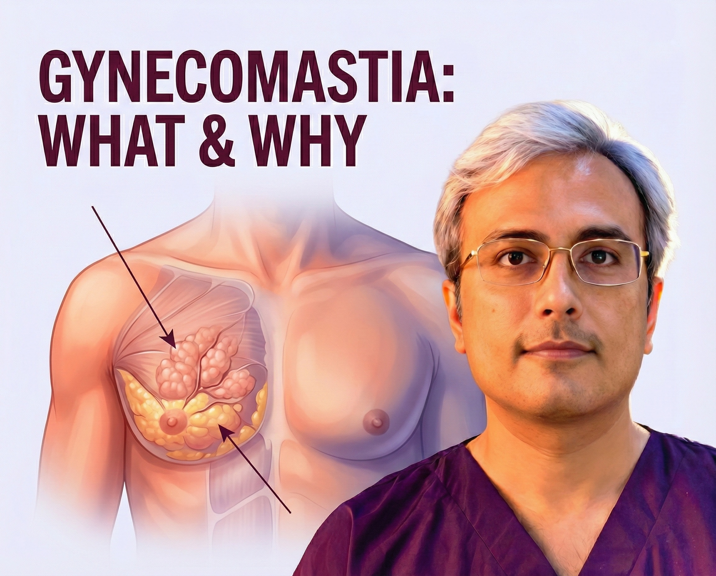 What is Gynecomastia? Causes, Symptoms, and Grades Explained