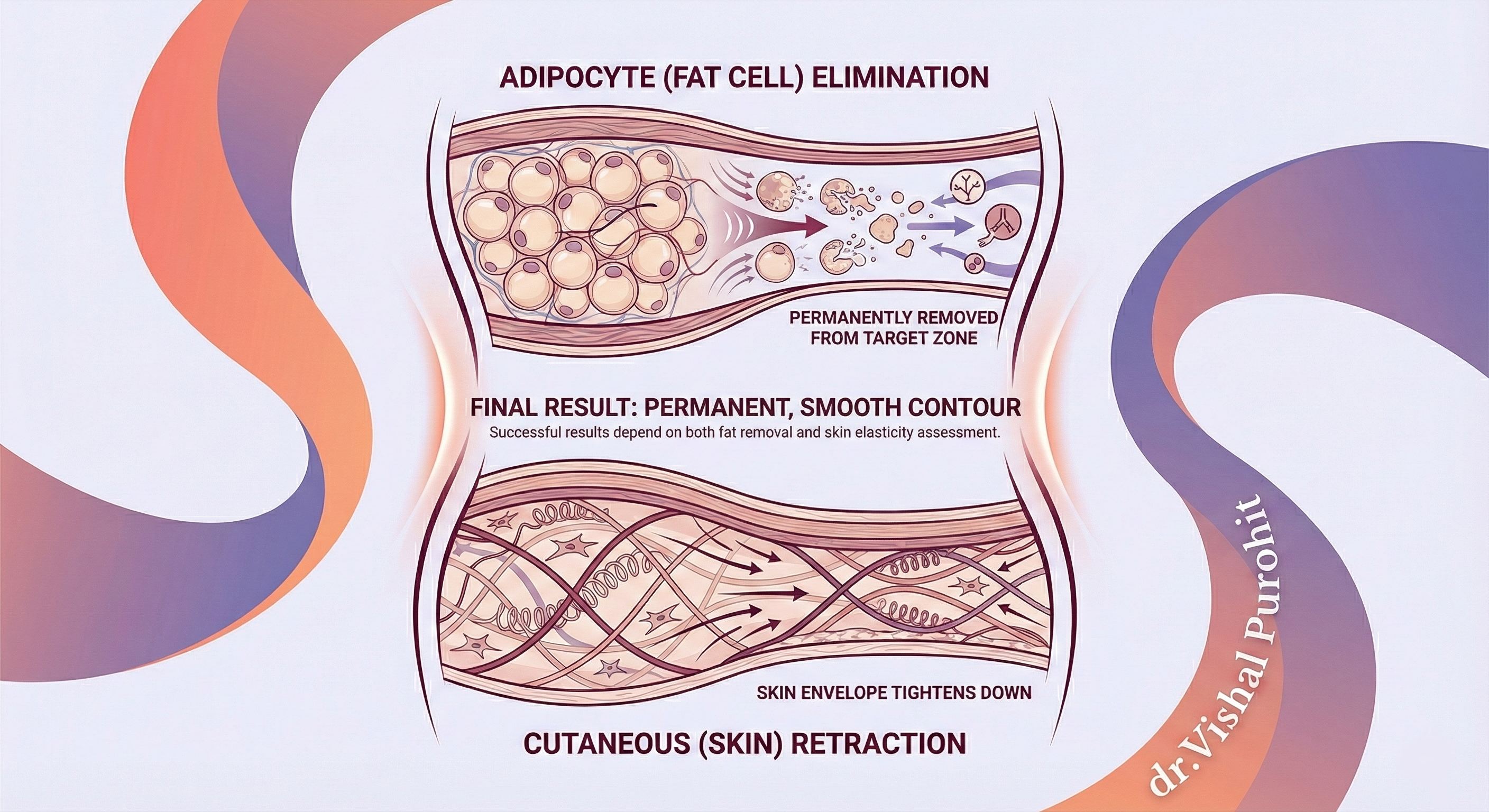 Anatomical cross-section showing a contoured body zone where deep lamellar fat has been eliminated and the dermal layer is tightening to fit the reduced volume.